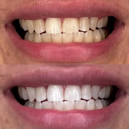 Crest 3D Whitestrips Professional Effects – Blanchiment Dentaire