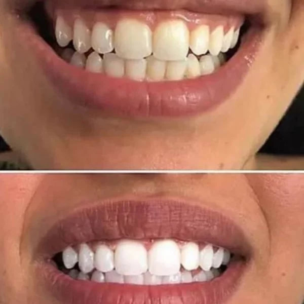 Crest 3D Whitestrips Professional Effects – Blanchiment Dentaire